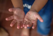 مرض اليد والقدم والفم عند الأطفال